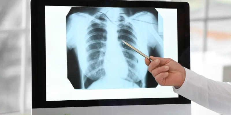 Aspergilosis pulmonar: Guía de atención especializada en Mérida