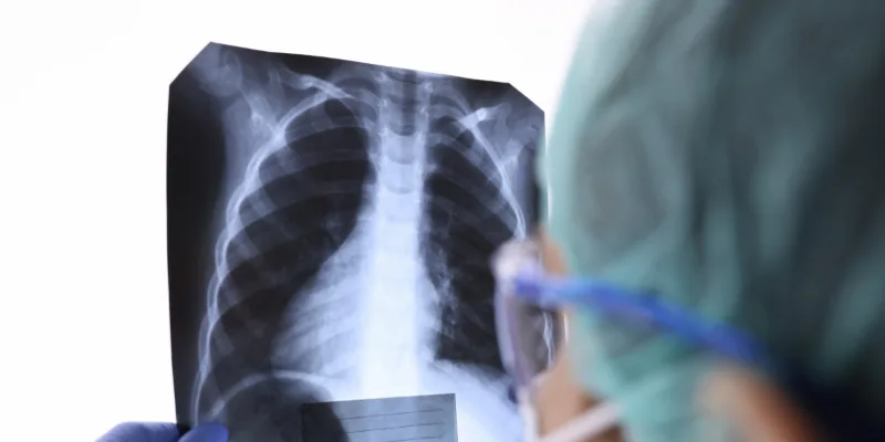 ¿Qué especialista trata la fibrosis pulmonar?