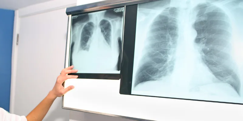 Nódulos pulmonares en Mérida: guía clínica completa y evaluación especializada